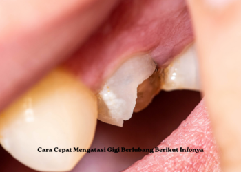 Cara Cepat Mengatasi Gigi Berlubang Berikut Infonya